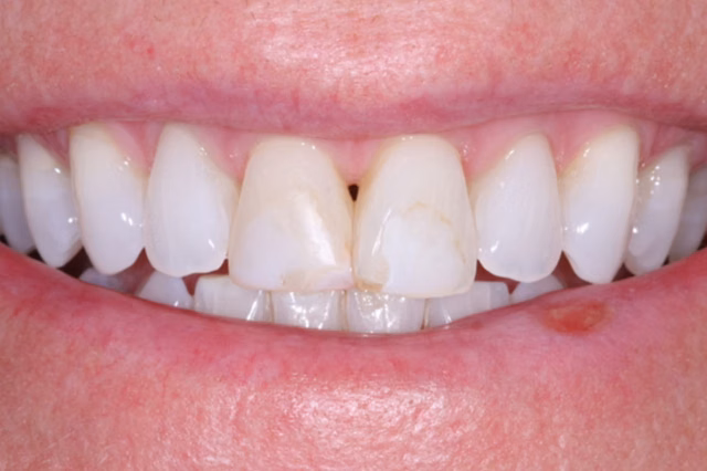Dental Veneers before at The Dentistry Collective in San Diego, CA