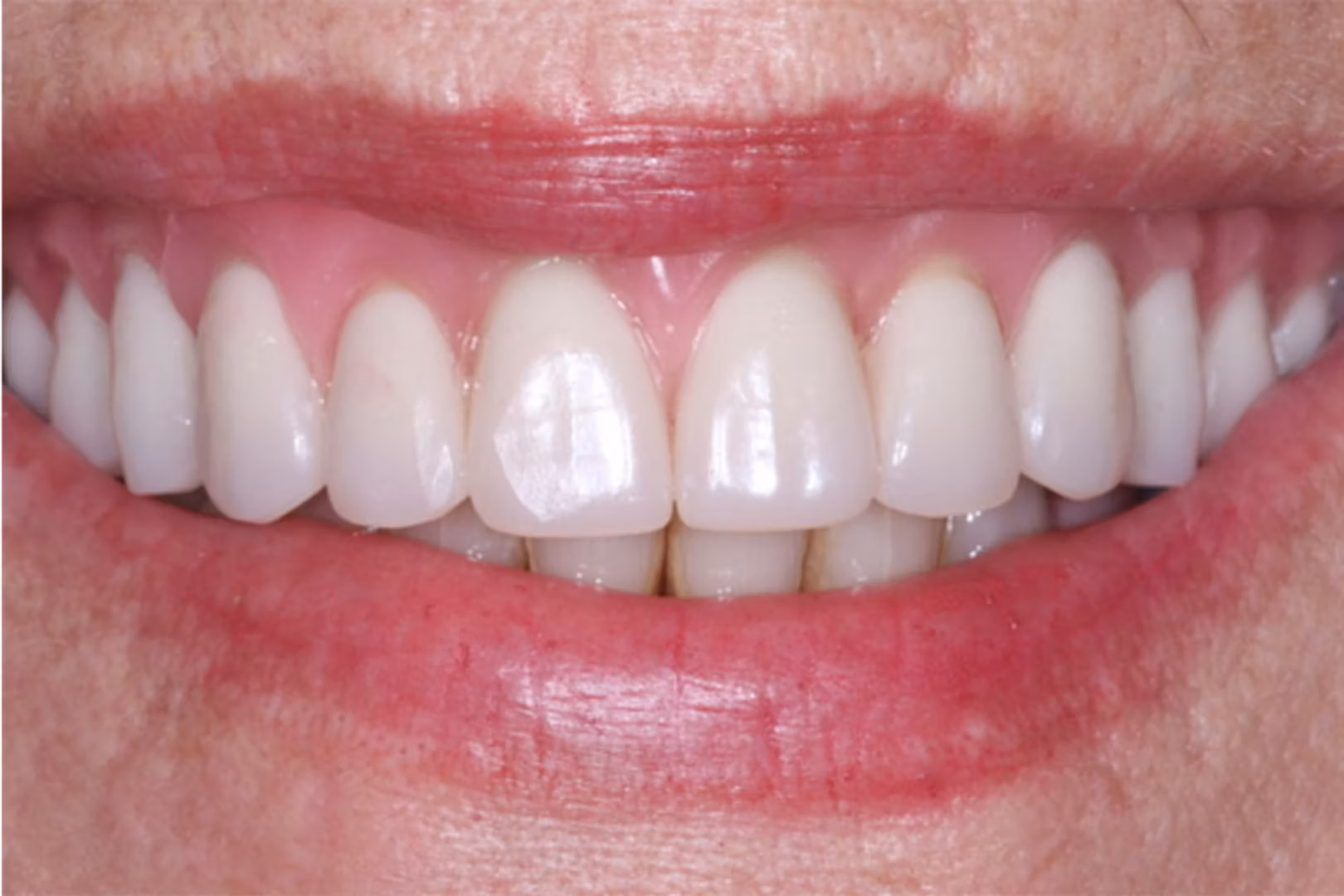 The Dentistry Collective smile makeover after — San Diego, CA