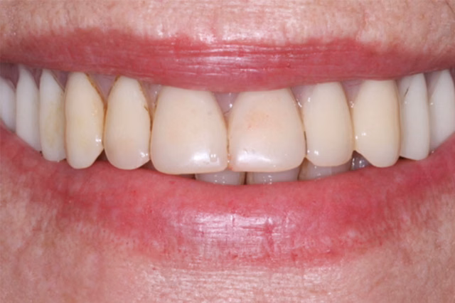 Smile Makeover before at The Dentistry Collective in San Diego, CA