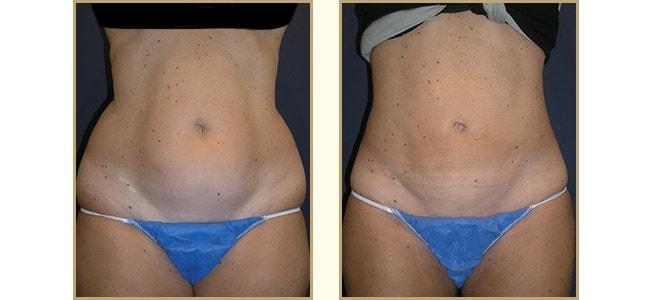 The Plastic Surgery Center (Lawrence Rosenberg, MD) liposuction result — Timonium, MD