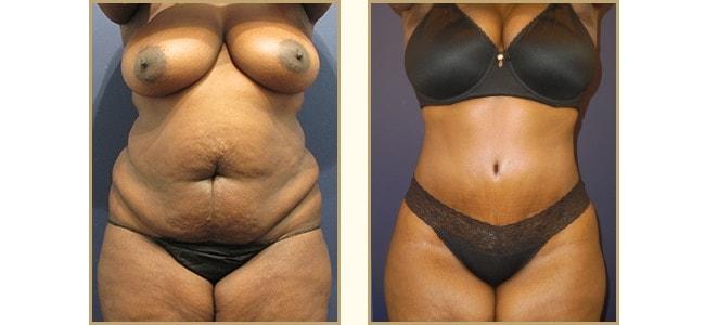 The Plastic Surgery Center (Lawrence Rosenberg, MD) tummy tuck result — Timonium, MD