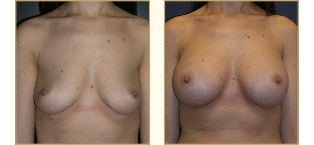 Breast Lift result at The Plastic Surgery Center (Lawrence Rosenberg, MD) in Timonium, MD