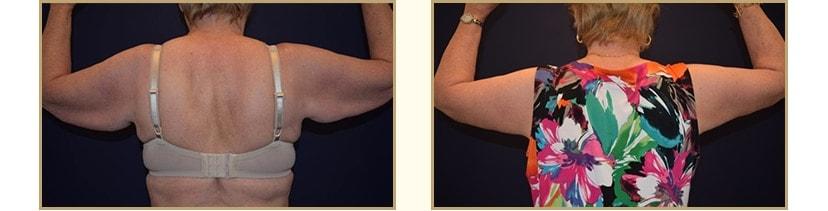 The Plastic Surgery Center (Lawrence Rosenberg, MD) arm lift result — Timonium, MD