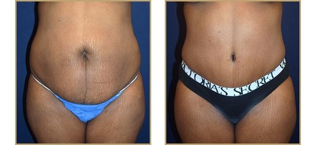 The Plastic Surgery Center (Lawrence Rosenberg, MD) tummy tuck result — Timonium, MD