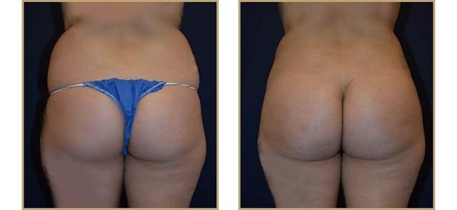 Brazilian Butt Lift result at The Plastic Surgery Center (Lawrence Rosenberg, MD) in Timonium, MD