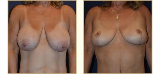 Breast Lift result at The Plastic Surgery Center (Lawrence Rosenberg, MD) in Timonium, MD
