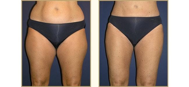 The Plastic Surgery Center (Lawrence Rosenberg, MD) liposuction result — Timonium, MD