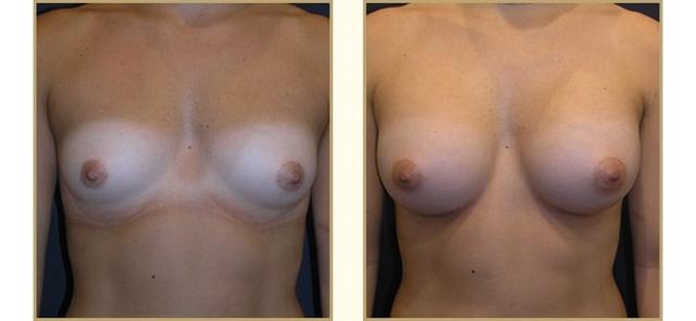 Breast Lift result at The Plastic Surgery Center (Lawrence Rosenberg, MD) in Timonium, MD