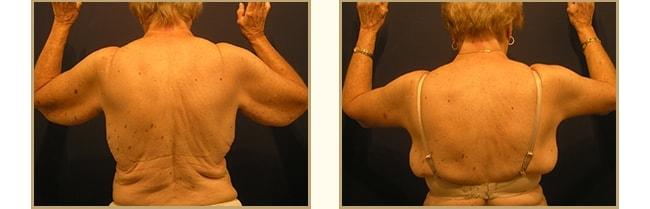 The Plastic Surgery Center (Lawrence Rosenberg, MD) arm lift result — Timonium, MD