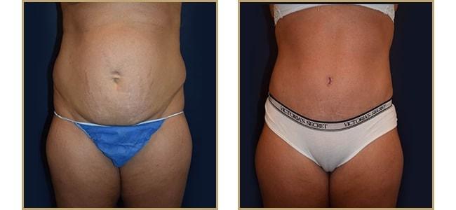 The Plastic Surgery Center (Lawrence Rosenberg, MD) tummy tuck result — Timonium, MD