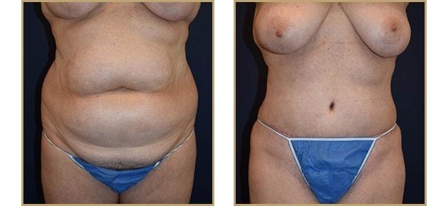 The Plastic Surgery Center (Lawrence Rosenberg, MD) tummy tuck result — Timonium, MD