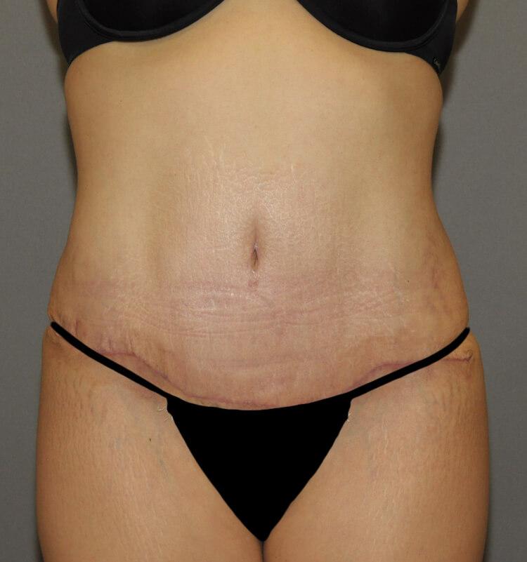Scottsdale Plastic Surgery tummy tuck after — Scottsdale, AZ