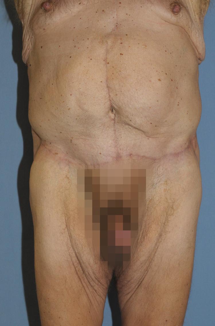Scottsdale Plastic Surgery tummy tuck after — Scottsdale, AZ