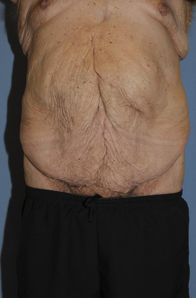 Tummy Tuck before at Scottsdale Plastic Surgery in Scottsdale, AZ