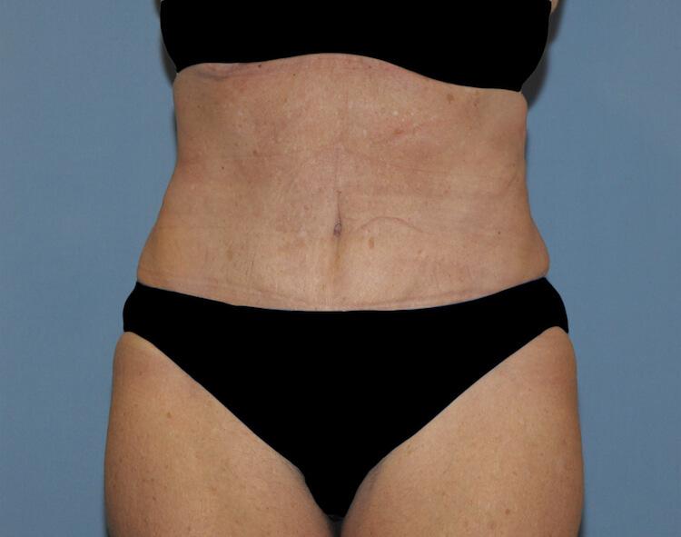Scottsdale Plastic Surgery tummy tuck after — Scottsdale, AZ
