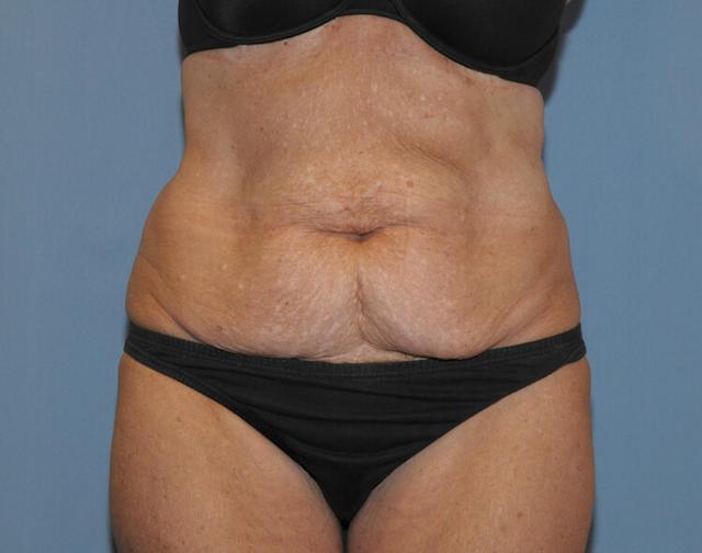 Mini Tummy Tuck before at Scottsdale Plastic Surgery in Paradise Valley, AZ
