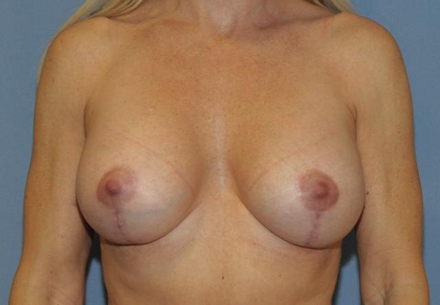 Breast Augmentation after at Scottsdale Plastic Surgery in Scottsdale, AZ