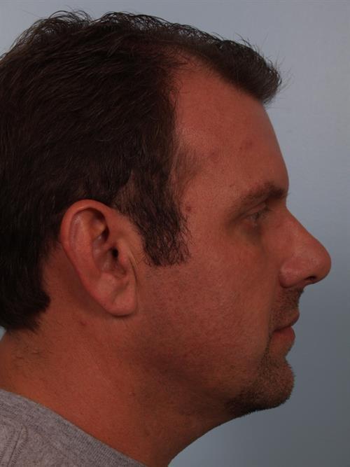 Chin Implant after at Scottsdale Plastic Surgery in Paradise Valley, AZ