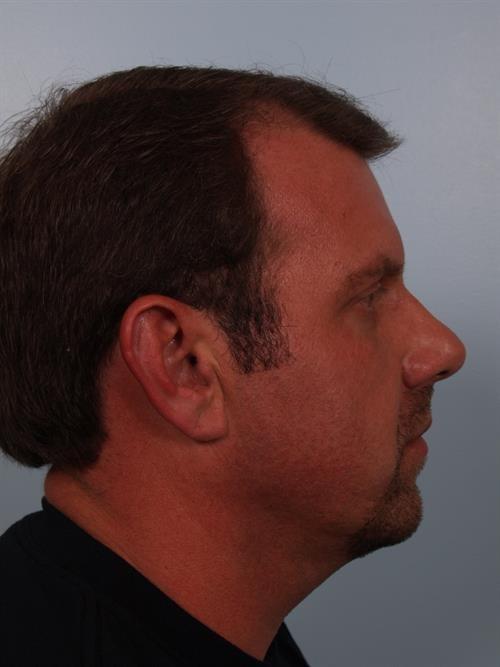 Chin Implant before at Scottsdale Plastic Surgery in Paradise Valley, AZ