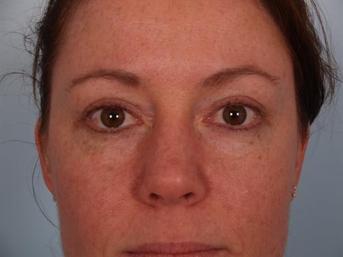 Blepharoplasty after at Scottsdale Plastic Surgery in Paradise Valley, AZ