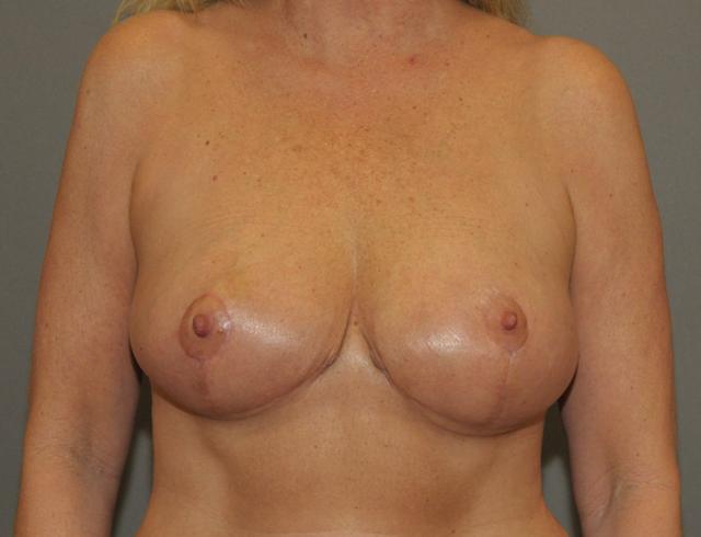 Breast Reduction after at Scottsdale Plastic Surgery in Scottsdale, AZ