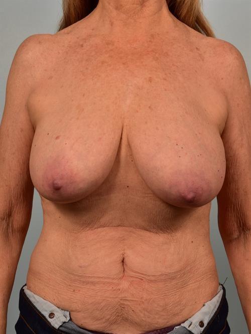 Breast Lift before at Scottsdale Plastic Surgery in Paradise Valley, AZ