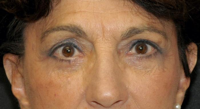 Scottsdale Plastic Surgery facelift after — Scottsdale, AZ