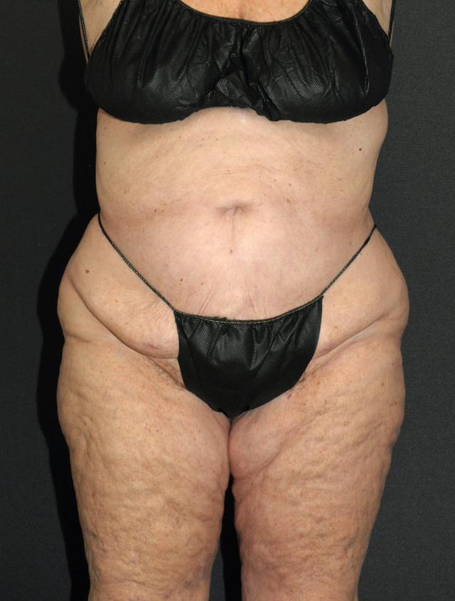 Liposuction after at Scottsdale Plastic Surgery in Scottsdale, AZ