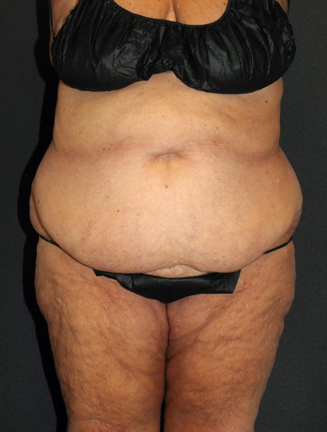 Liposuction before at Scottsdale Plastic Surgery in Scottsdale, AZ