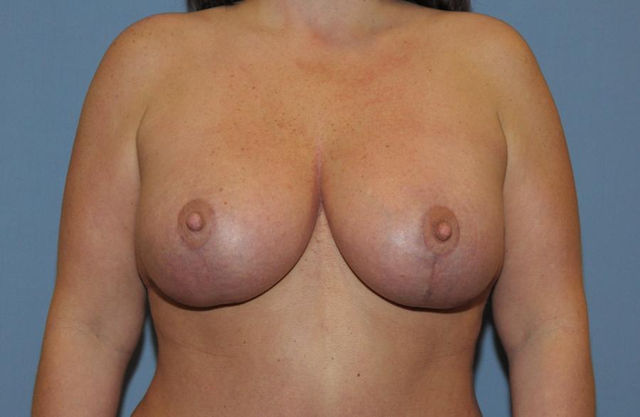 Scottsdale Plastic Surgery facelift after — Scottsdale, AZ