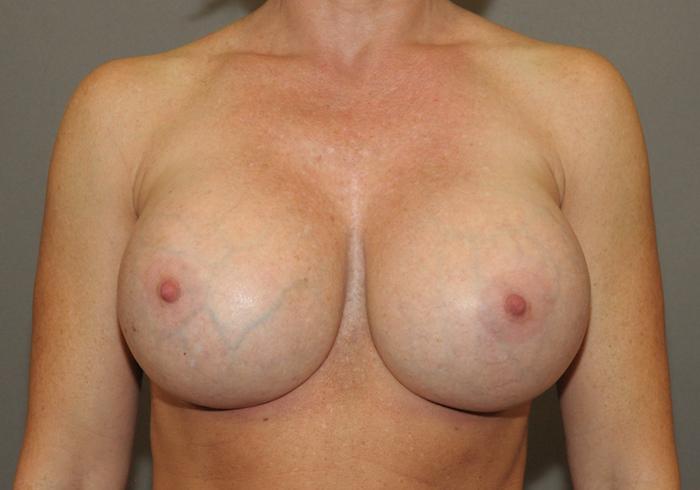 Scottsdale Plastic Surgery breast augmentation after — Scottsdale, AZ
