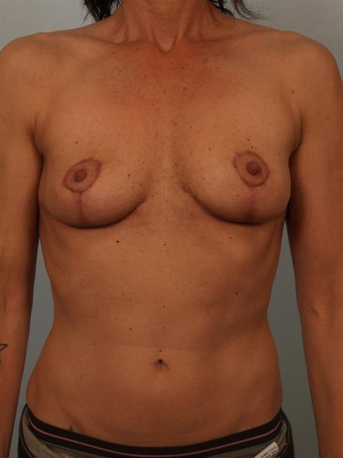Scottsdale Plastic Surgery breast implant removal after — Paradise Valley, AZ