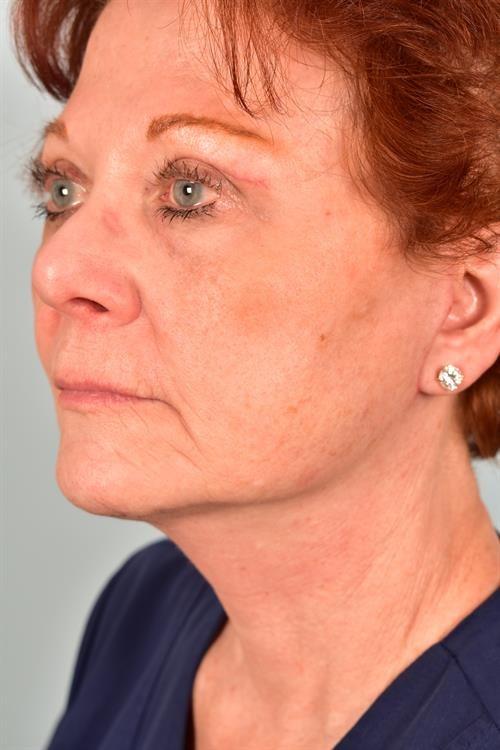 Facelift after at Scottsdale Plastic Surgery in Paradise Valley, AZ