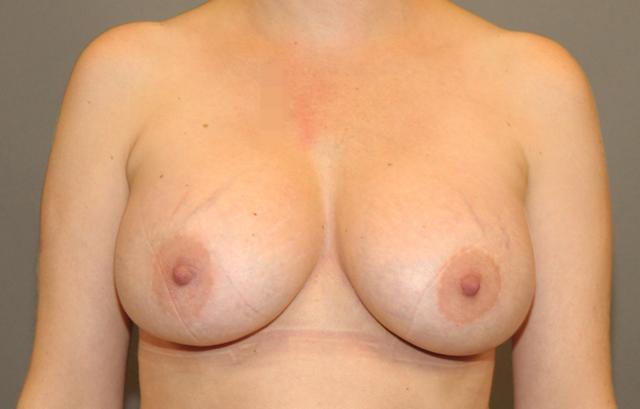 Breast Augmentation after at Scottsdale Plastic Surgery in Scottsdale, AZ
