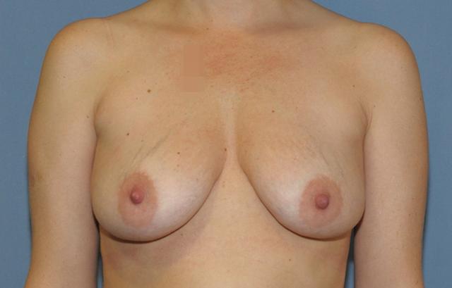 Breast Augmentation before at Scottsdale Plastic Surgery in Scottsdale, AZ