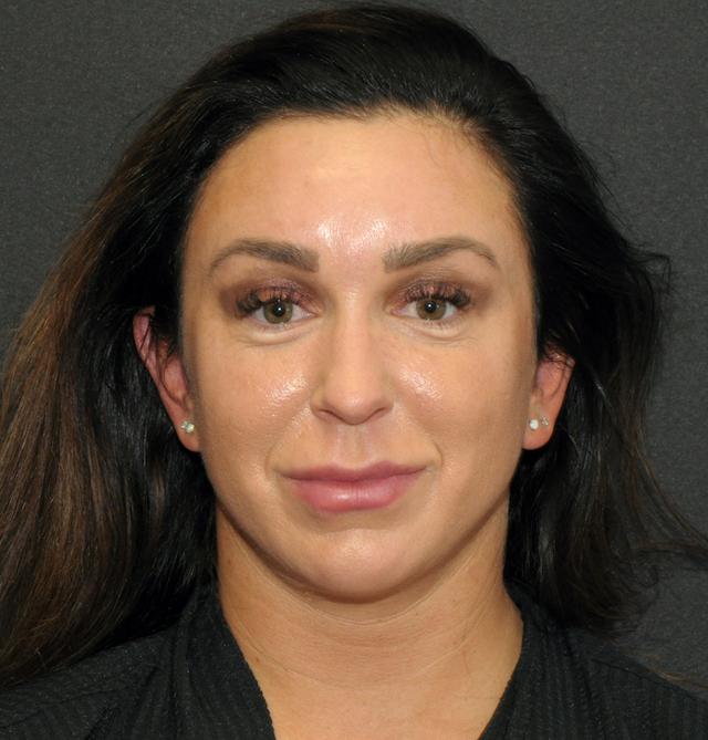 Liposuction after at Scottsdale Plastic Surgery in Scottsdale, AZ