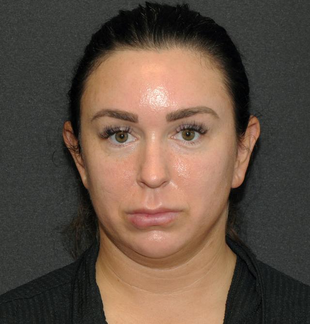 Liposuction before at Scottsdale Plastic Surgery in Scottsdale, AZ