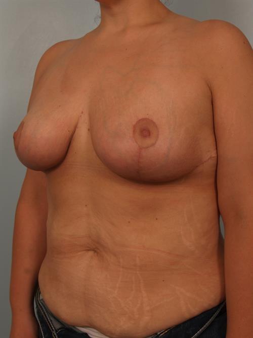Breast Reduction after at Scottsdale Plastic Surgery in Paradise Valley, AZ