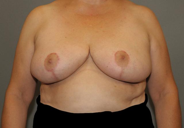 Breast Reduction after at Scottsdale Plastic Surgery in Scottsdale, AZ