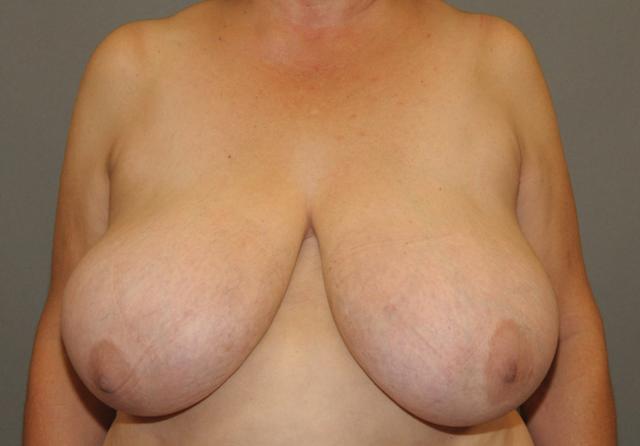 Breast Reduction before at Scottsdale Plastic Surgery in Scottsdale, AZ