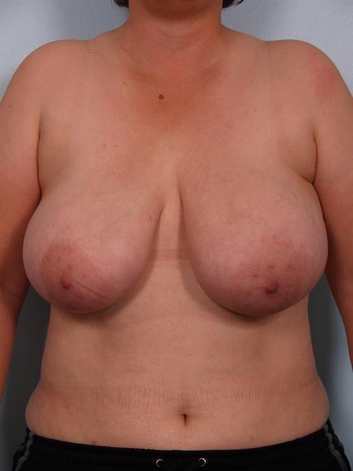 Breast Reduction before at Scottsdale Plastic Surgery in Paradise Valley, AZ