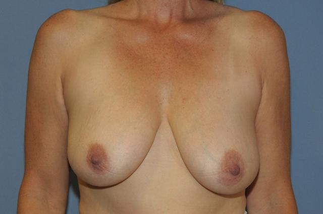 Neck Lift before at Scottsdale Plastic Surgery in Scottsdale, AZ