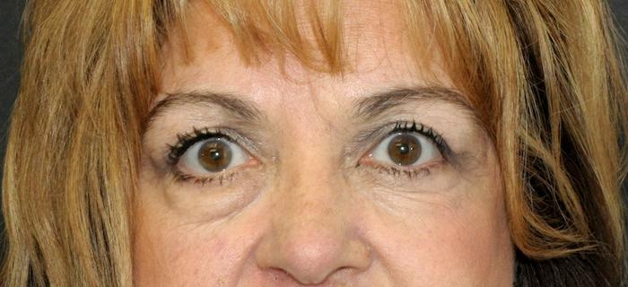 Scottsdale Plastic Surgery facelift after — Scottsdale, AZ
