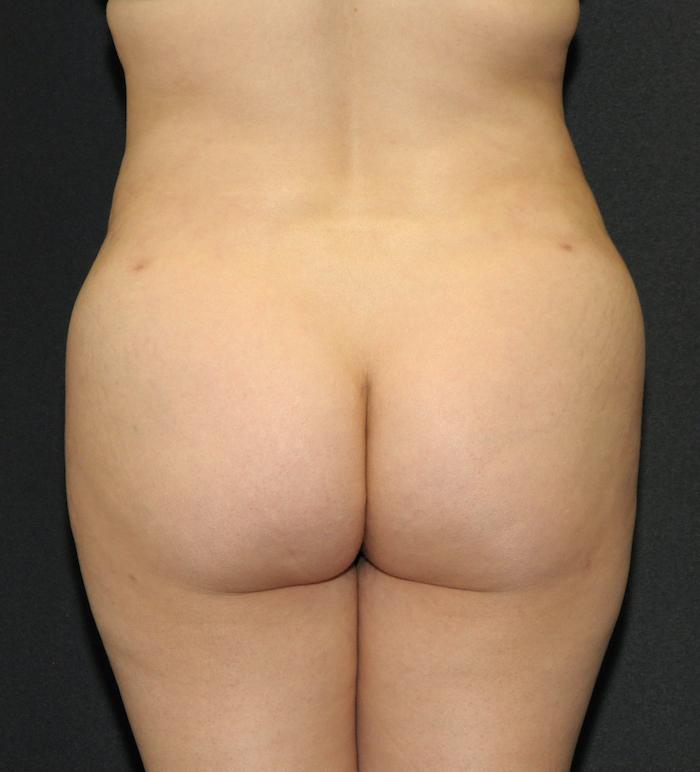 Scottsdale Plastic Surgery bbl after — Scottsdale, AZ
