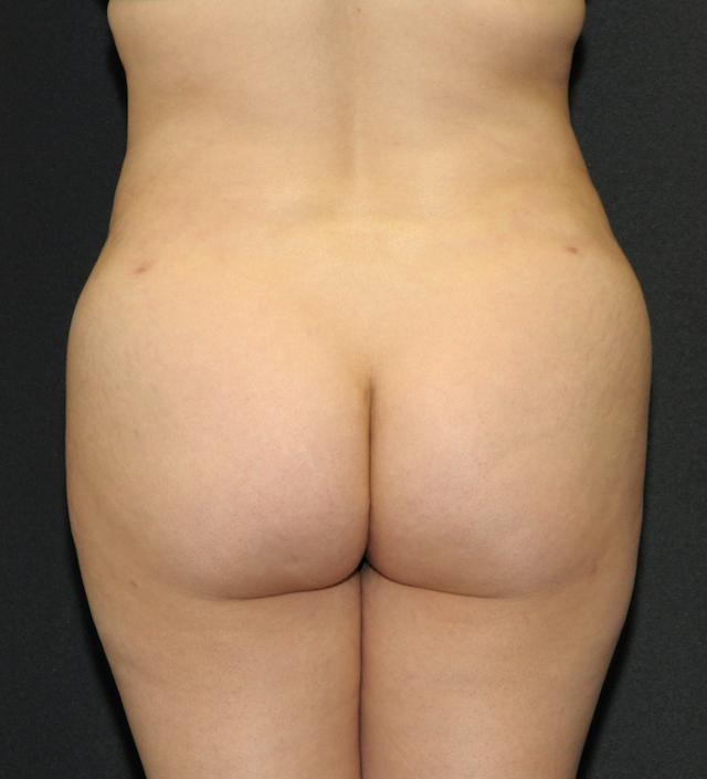 Brazilian Butt Lift after at Scottsdale Plastic Surgery in Scottsdale, AZ