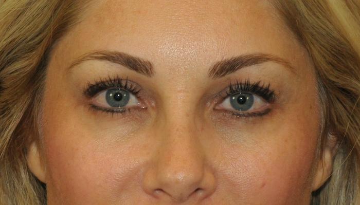 Scottsdale Plastic Surgery facelift after — Scottsdale, AZ