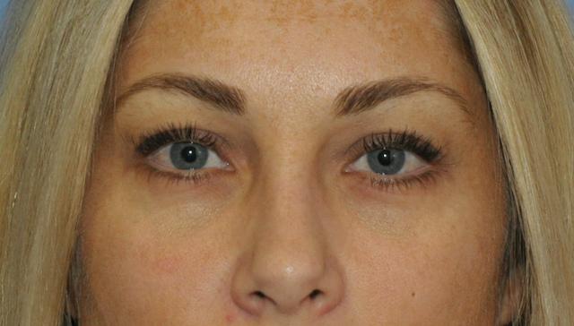 Blepharoplasty before at Scottsdale Plastic Surgery in Paradise Valley, AZ