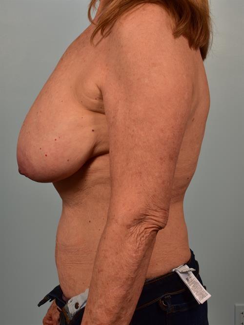 Breast Lift before at Scottsdale Plastic Surgery in Paradise Valley, AZ