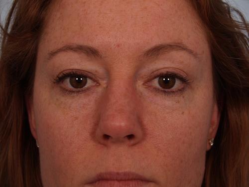 Blepharoplasty before at Scottsdale Plastic Surgery in Paradise Valley, AZ