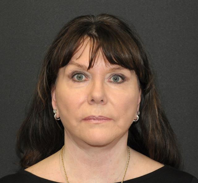 Mini Facelift after at Scottsdale Plastic Surgery in Scottsdale, AZ